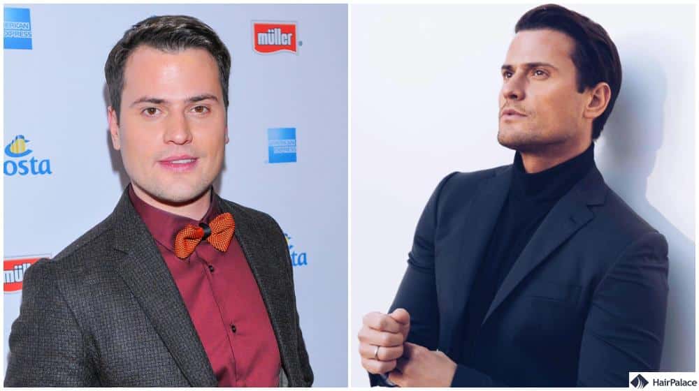 Rocco Stark promis haartransplantation vorher-nachher